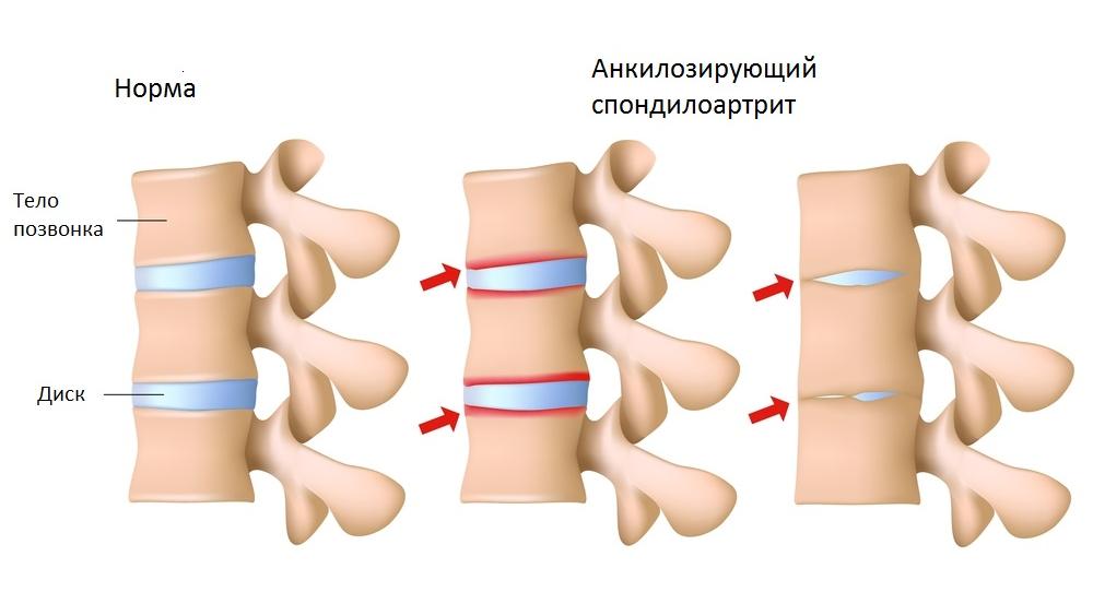 За болями в спине нередко скрывается тяжелая болезнь: советы специалиста